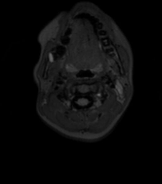 File:Choroid plexus carcinoma (Radiopaedia 91013-108553 Axial T2 fat sat 4).jpg