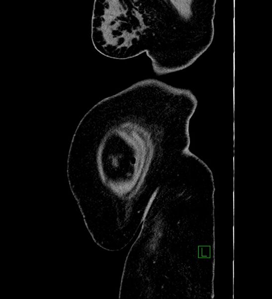 File:Chromophobe renal cell carcinoma (Radiopaedia 84239-99519 G 4).jpg