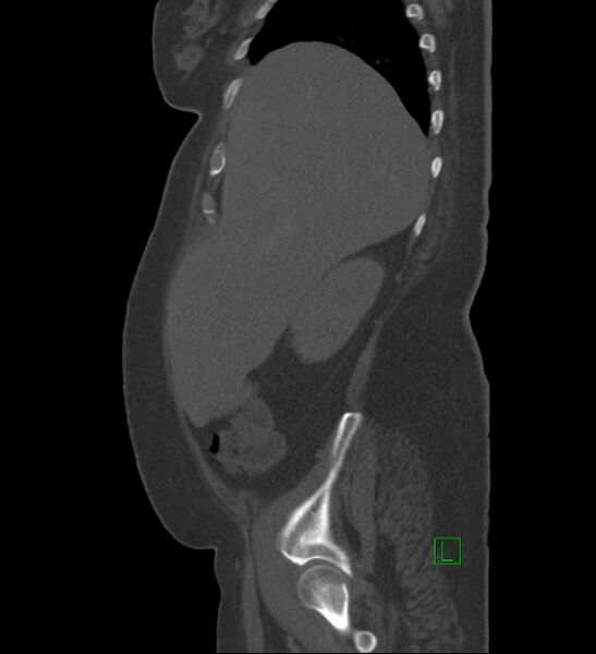 File:Chromophobe renal cell carcinoma (Radiopaedia 84239-99519 Sagittal bone window 86).jpg