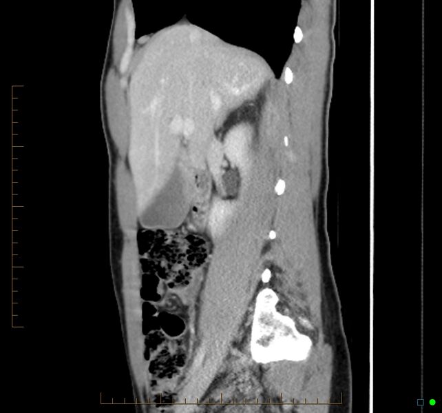 File:Chronic abscess due to "dropped" appendicoliths following appendectomy for perforated appendix (Radiopaedia 58805-66344 D 37).jpg