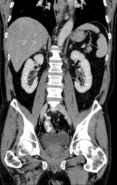 File:Chronic appendicitis complicated by appendicular abscess, pylephlebitis and liver abscess (Radiopaedia 54483-60700 C 50).jpg