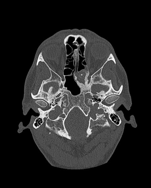 File:Chronic maxillary sinusitis caused by a foreign body (Radiopaedia 58521-65676 Axial bone window 207).jpg