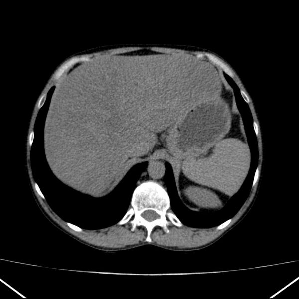 File:Chronic pancreatitis (Radiopaedia 23132-23172 Axial non-contrast 16).jpg
