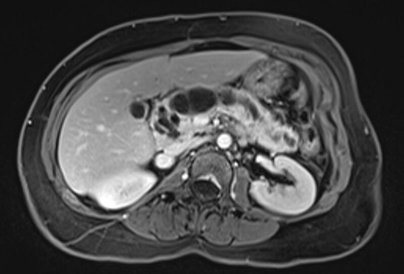 File:Chronic pancreatitis - pancreatic duct calculi (Radiopaedia 71818-82250 Axial T1 C+ fat sat 30).jpg