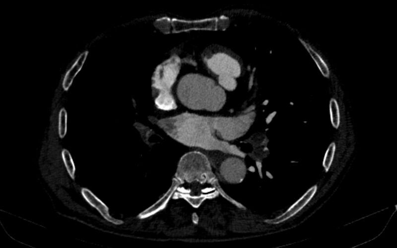 File:Chronic pulmonary embolism (Radiopaedia 91241-108843 B 107).jpg