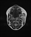 Chronic reactive multifocal osteomyelitis (CRMO) - mandible (Radiopaedia 56405-63069 Axial T2 12).jpg