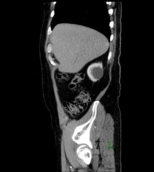 File:Clear cell renal cell carcinoma (Radiopaedia 85006-100539 E 50).jpg