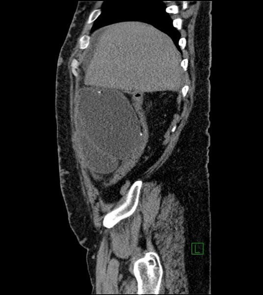 File:Closed-loop small bowel obstruction-internal hernia (Radiopaedia 78439-91096 C 117).jpg