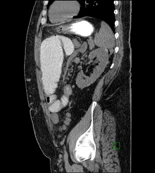 File:Closed-loop small bowel obstruction-internal hernia (Radiopaedia 78439-91096 C 49).jpg