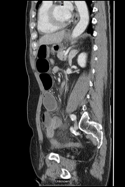 File:Closed loop bowel obstruction and ischemia (Radiopaedia 86959-103180 C 23).jpg