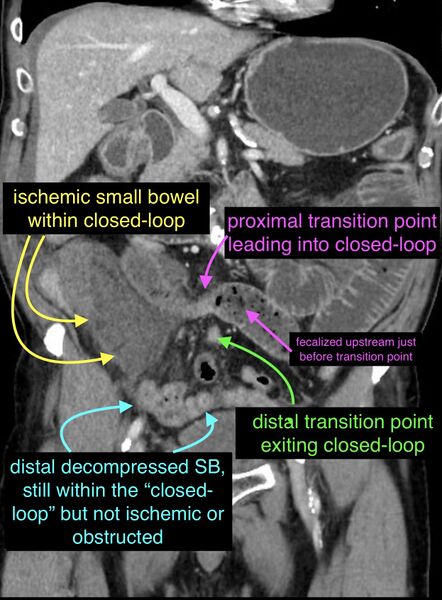 File:Closed loop obstruction due to adhesive band, resulting in small bowel ischemia and resection (Radiopaedia 83835-100015 A 1).jpg