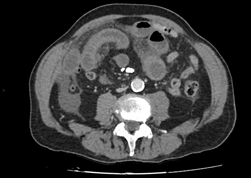 File:Closed loop small bowel obstruction with ischemia (Radiopaedia 84180-99456 A 66).jpg