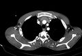 Coarctation of aorta with aortic valve stenosis (Radiopaedia 70463-80574 A 15).jpg