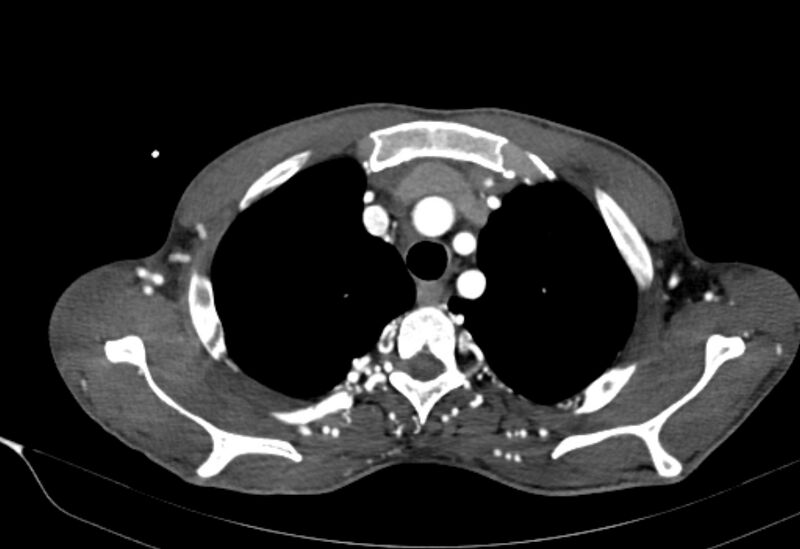 File:Coarctation of aorta with aortic valve stenosis (Radiopaedia 70463-80574 A 15).jpg