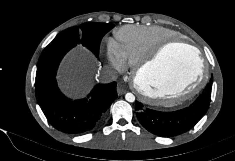 File:Coarctation of aorta with aortic valve stenosis (Radiopaedia 70463-80574 A 175).jpg