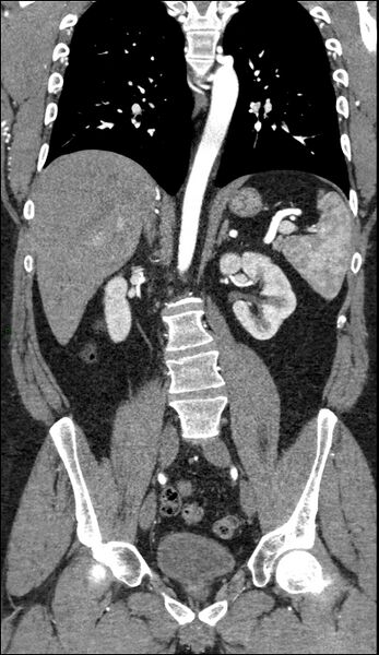 File:Coarctation of the aorta (Radiopaedia 74632-88521 B 143).jpg