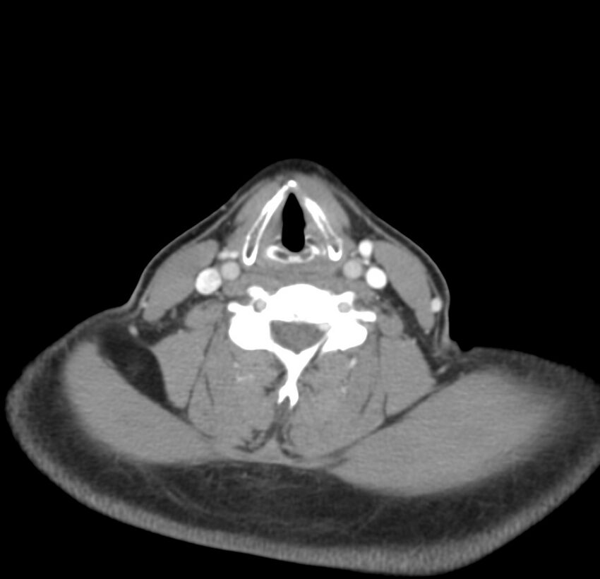 Colloid cyst of thyroid (Radiopaedia 22897-22923 Axial C+ delayed 49).jpg