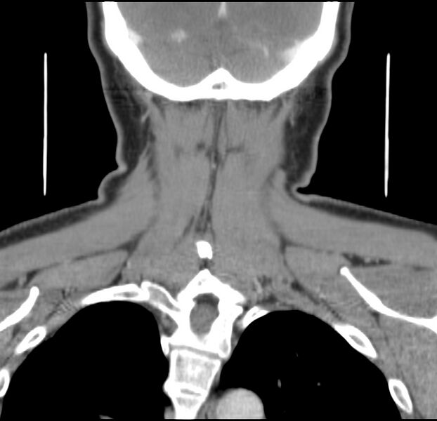 File:Colloid cyst of thyroid (Radiopaedia 22897-22923 Coronal C+ delayed 52).jpg