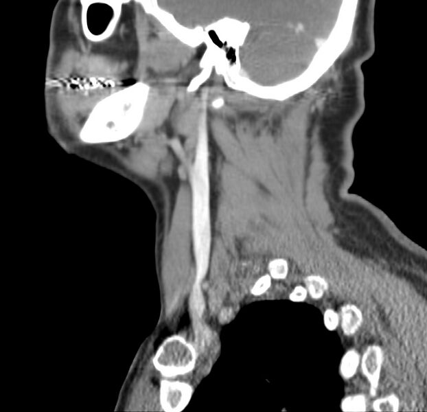 File:Colloid cyst of thyroid (Radiopaedia 22897-22923 Sagittal C+ delayed 18).jpg