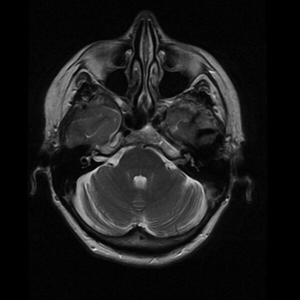 File:Colloid cyst with hydrocephalus (Radiopaedia 9373-10065 Axial T2 5).jpg