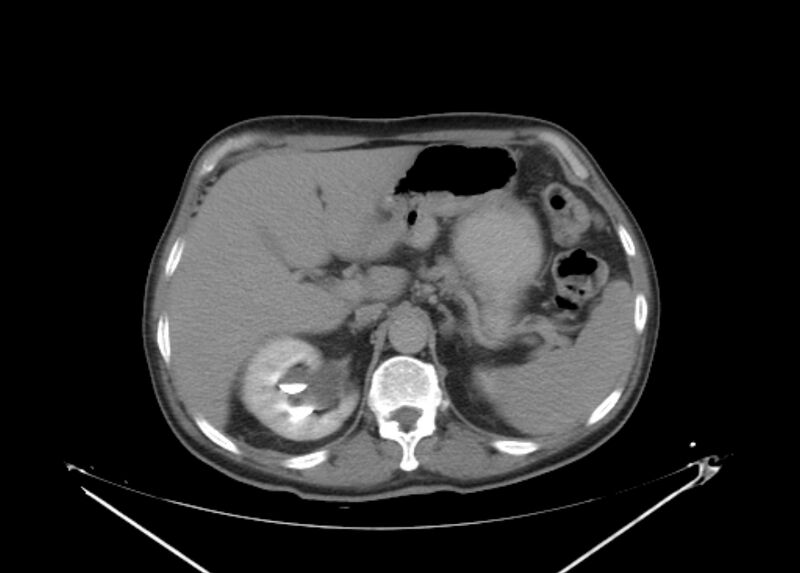 File:Colon cancer mimicking renal cell carcinoma (Radiopaedia 28986-29335 Axial C+ delayed 19).jpg