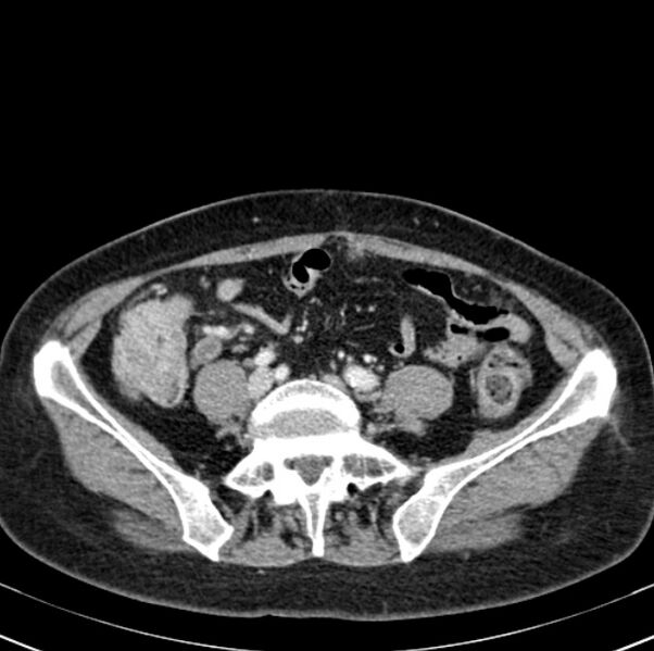 File:Colon carcinoma with hepatic metastases (Radiopaedia 29477-29961 A 78).jpg