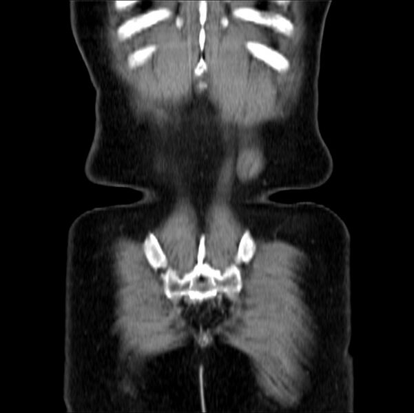File:Colon carcinoma with hepatic metastases (Radiopaedia 29477-29961 B 41).jpg