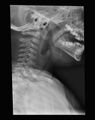 Epiglottitis (Radiopaedia 8414).jpg