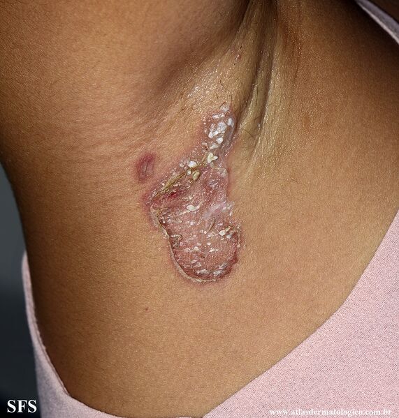 File:Impetigo (Dermatology Atlas 100).jpg