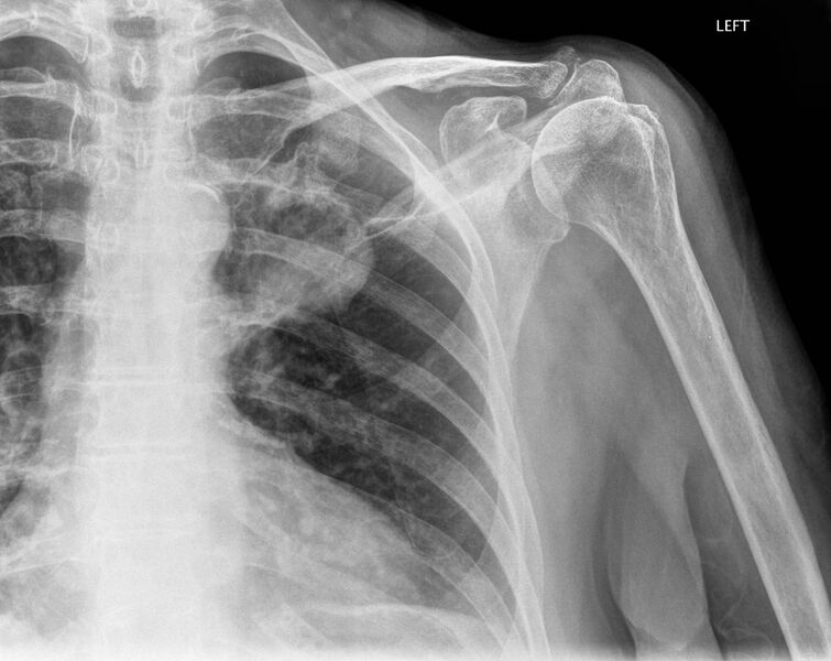 File:Lung cancer - shoulder radiograph (Radiopaedia 37963).jpg