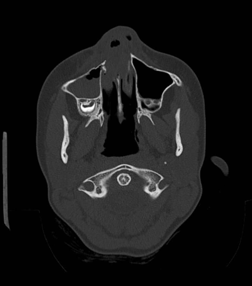 Nasoorbitoethmoid fracture (Radiopaedia 90044-107205 Axial bone window 57).jpg