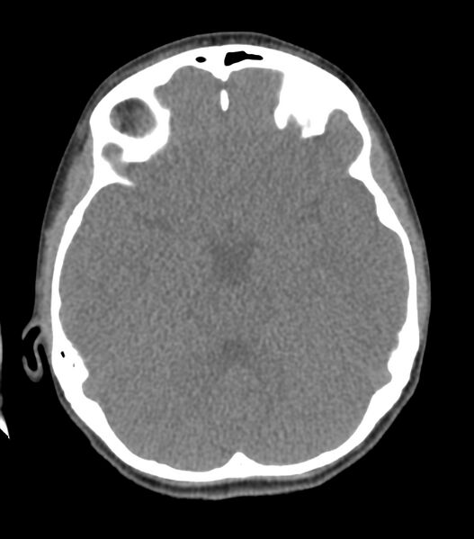 File:Nasoorbitoethmoid fracture (Radiopaedia 90044-107205 Axial non-contrast 184).jpg