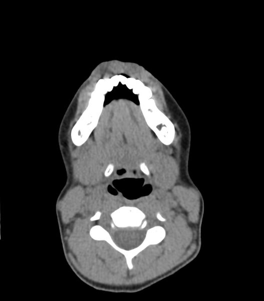 File:Nasoorbitoethmoid fracture (Radiopaedia 90044-107205 Axial non-contrast 51).jpg