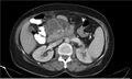 Necrotizing pancreatitis (Radiopaedia 20595-20495 A 16).jpg
