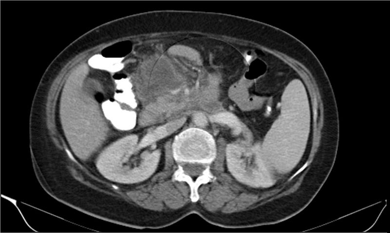 File:Necrotizing pancreatitis (Radiopaedia 20595-20495 A 16).jpg