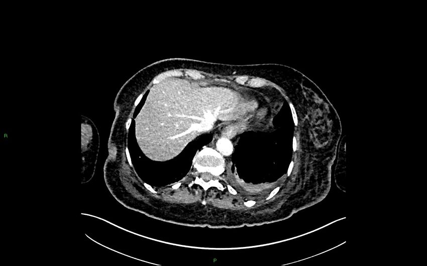 Neo-terminal ileal stricture (Crohn disease) (Radiopaedia 33790-34948 A 46).jpg