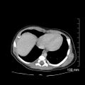 Neonatal neuroblastoma (Radiopaedia 56651-63438 Axial non-contrast 11).jpg