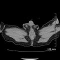 Neonatal neuroblastoma (Radiopaedia 56651-63438 Axial non-contrast 90).jpg