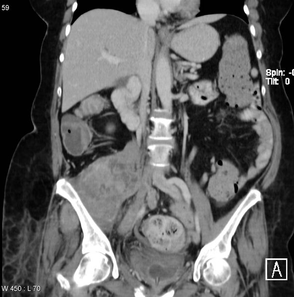 File:Nerve sheath tumor - malignant - sacrum (Radiopaedia 5219-6987 B 5).jpg
