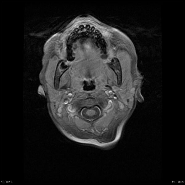 File:Neurofibromatosis type 1 (Radiopaedia 22541-22564 Axial T1 C+ fat sat 11).jpg