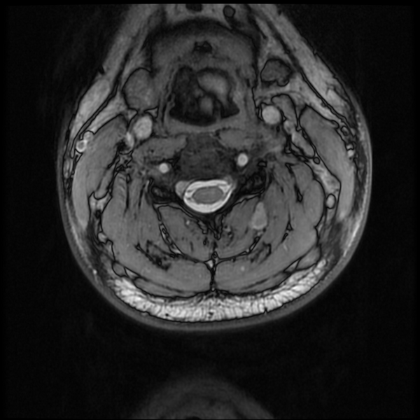 File:Neurofibromatosis type 2 (Radiopaedia 44936-48837 Axial Gradient Echo 28).png