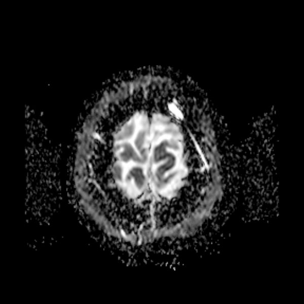 File:Neurofibromatosis type 2 (Radiopaedia 67470-76871 Axial ADC 22).jpg