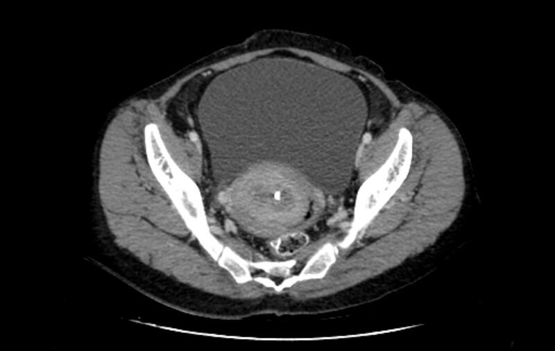 File:Non-puerperal uterine inversion (Radiopaedia 78343-91094 A 18).jpg