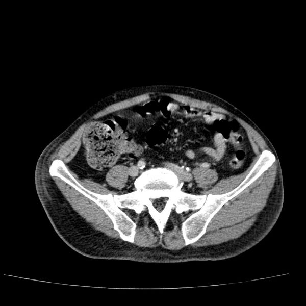 File:Non small-cell lung cancer (Radiopaedia 24467-24769 C+ delayed 95).jpg