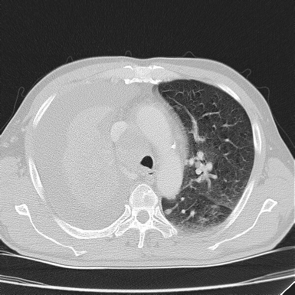 File:Non small-cell lung cancer (Radiopaedia 24467-24769 lung window 16).jpg