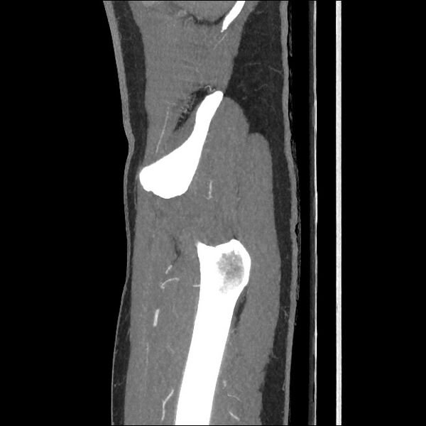 File:Normal CT angiogram of pelvis (Radiopaedia 45390-49430 C 13).jpg
