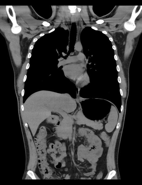 File:Normal CT virtual gastroscopy (Radiopaedia 29960-30501 E 8).jpg