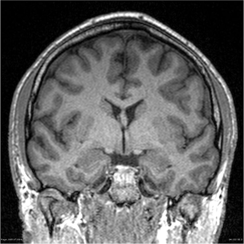 Normal brain MRI (non-focal epilepsy protocol) (Radiopaedia 38571-40700 Coronal T1 60).jpg