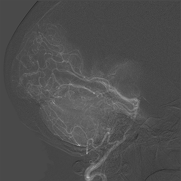 File:Normal cerebral angiogram (four vessel DSA) (Radiopaedia 41708-44649 L 12).png