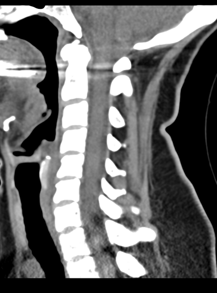 File:Normal cervical spine MRI (including Dixon) (Radiopaedia 42762-45926 C 32).png